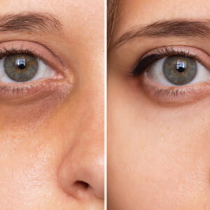 Under Eye Darkness