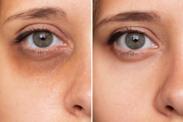 Under Eye Darkness