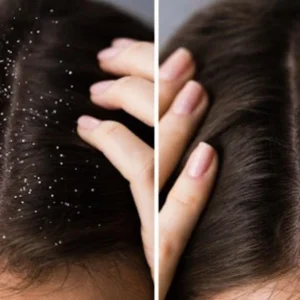 Dandruff Treatment