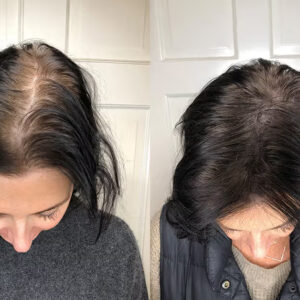 Hair Falling Treatment