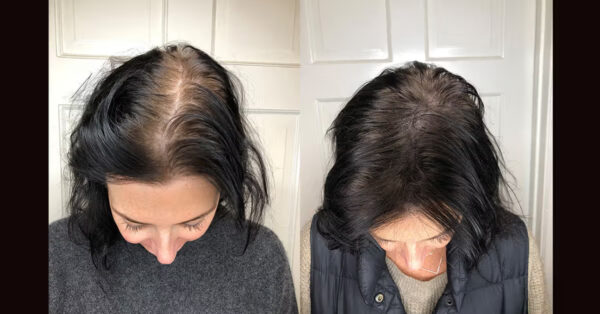 Hair Falling Treatment